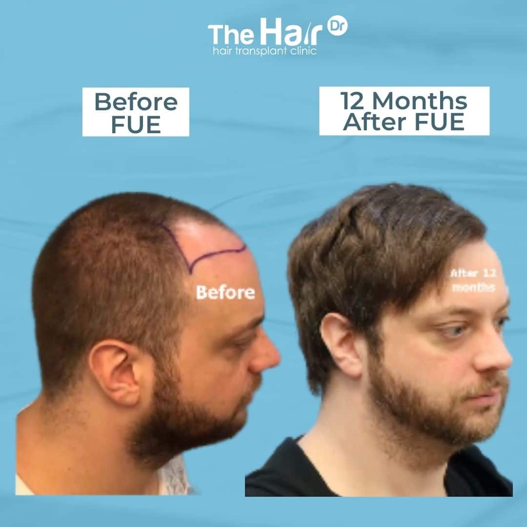 Patient transformation slide 3