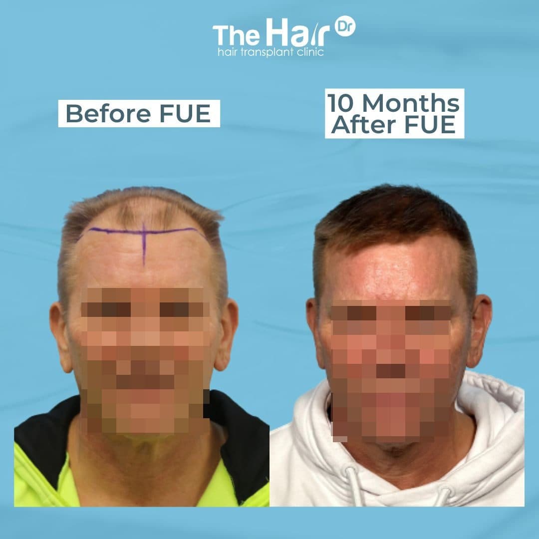 Patient transformation slide 3
