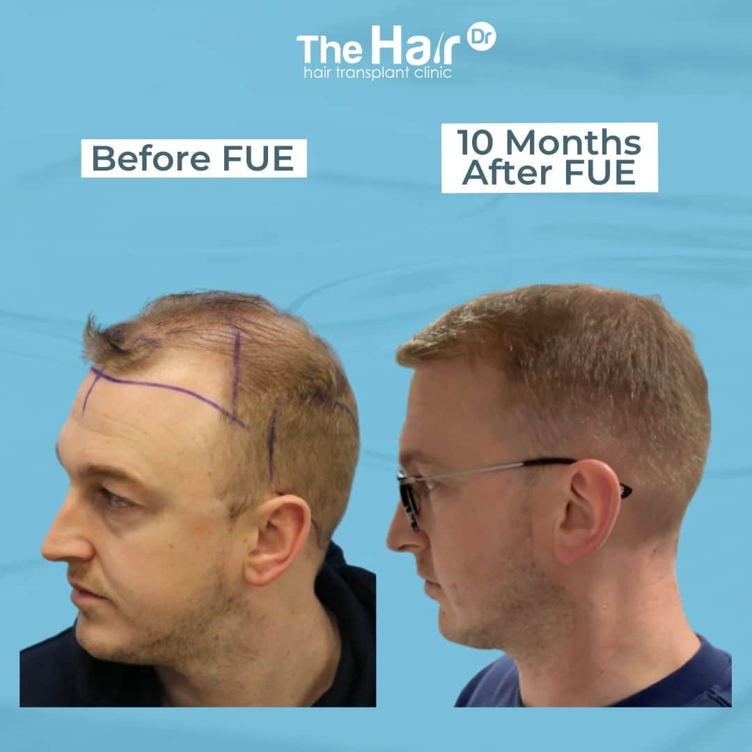 Patient transformation slide 2