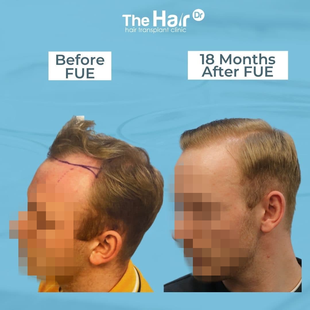 Patient transformation slide 3