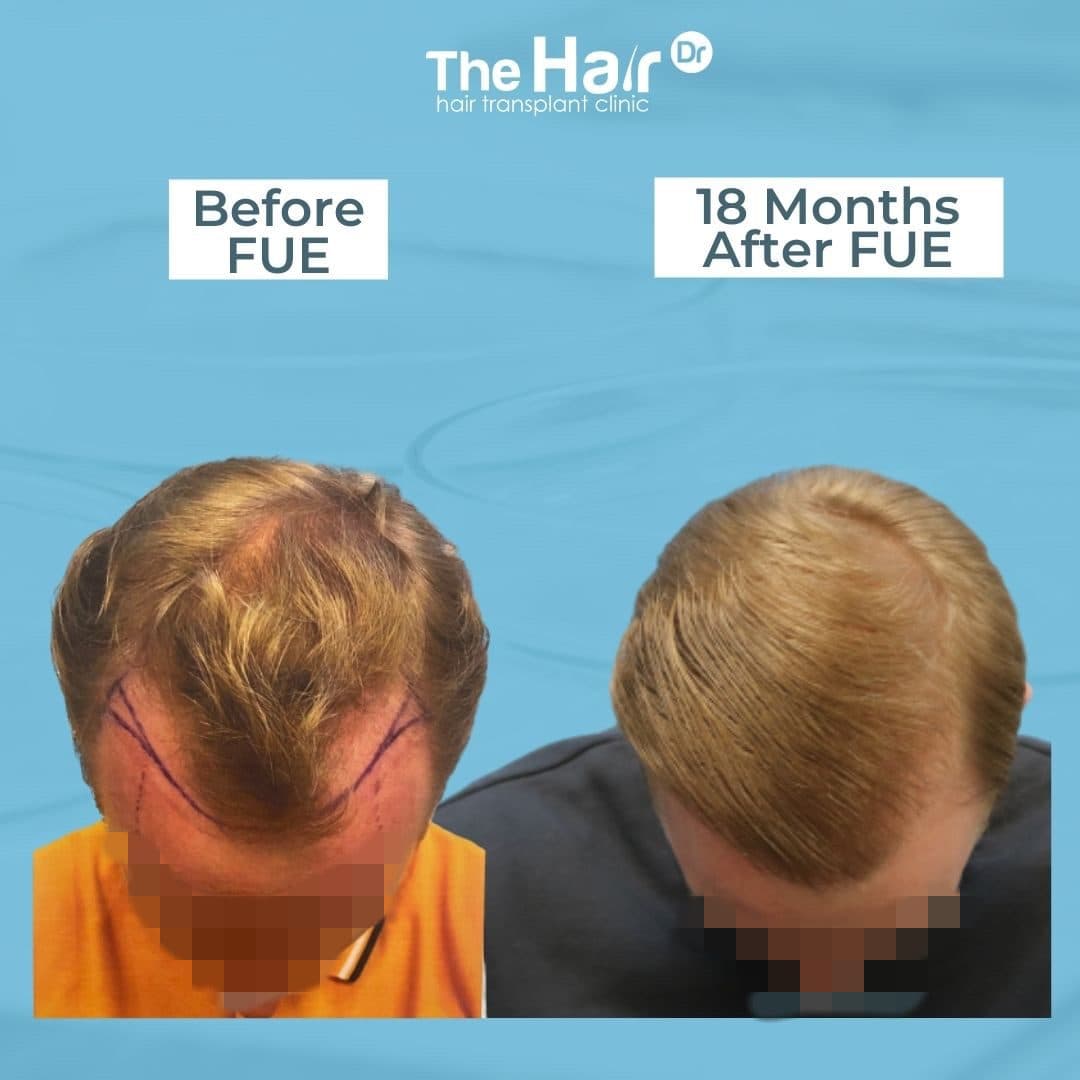 Patient transformation slide 4