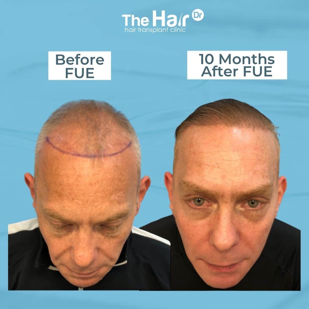 Patient transformation slide 5