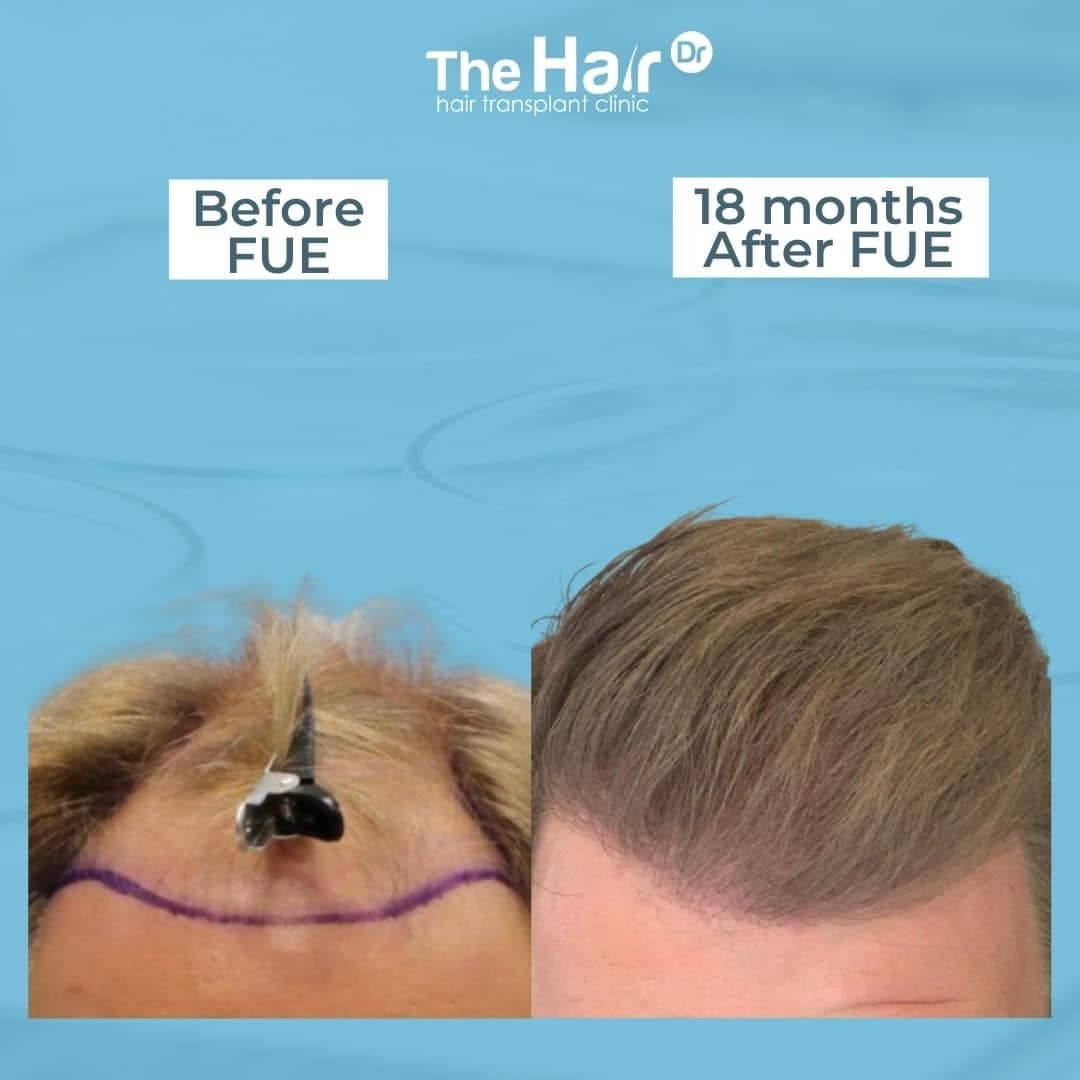 Patient transformation slide 3
