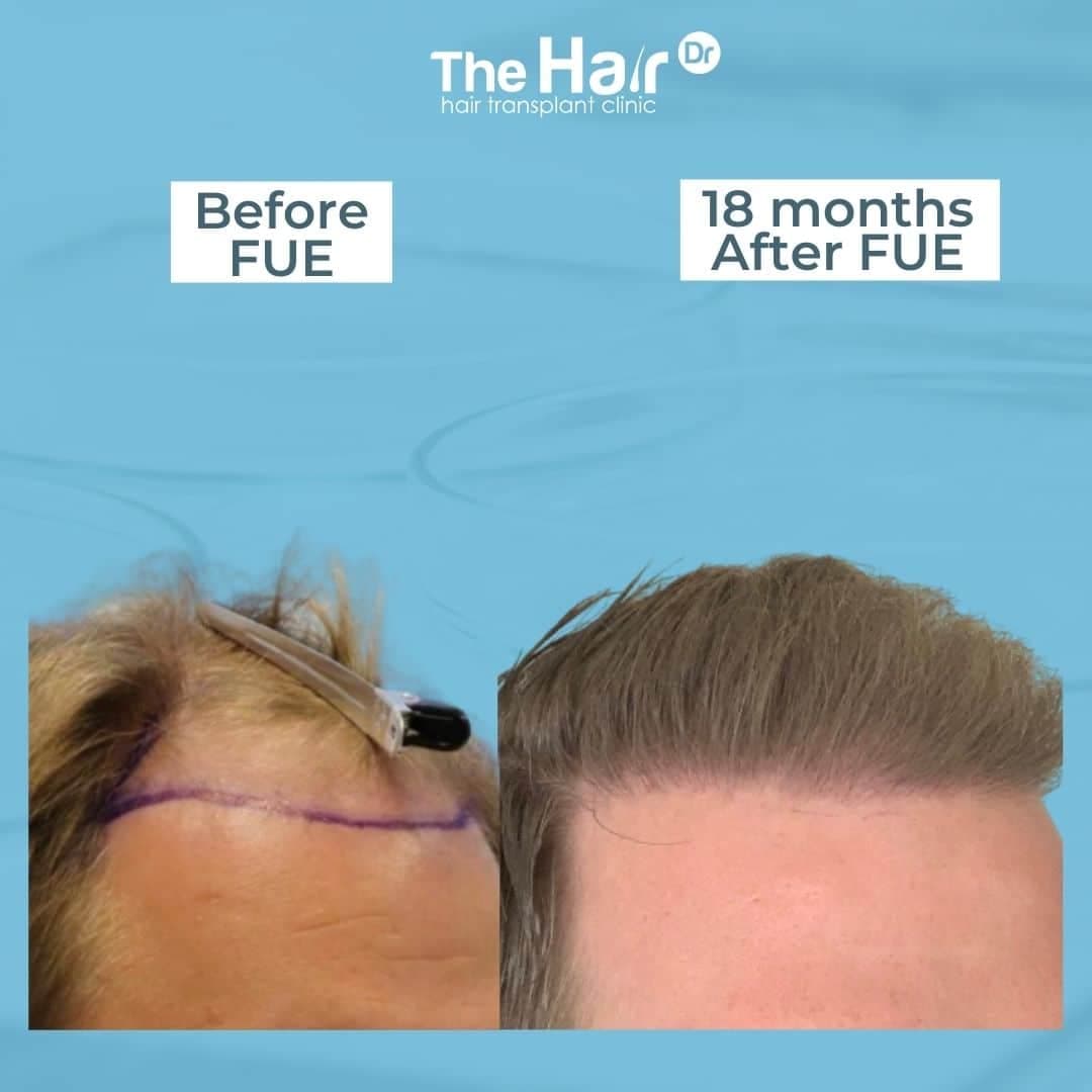 Patient transformation slide 5