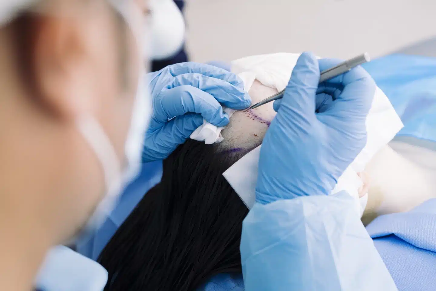 Hair Transplant Surgery FUE FUT