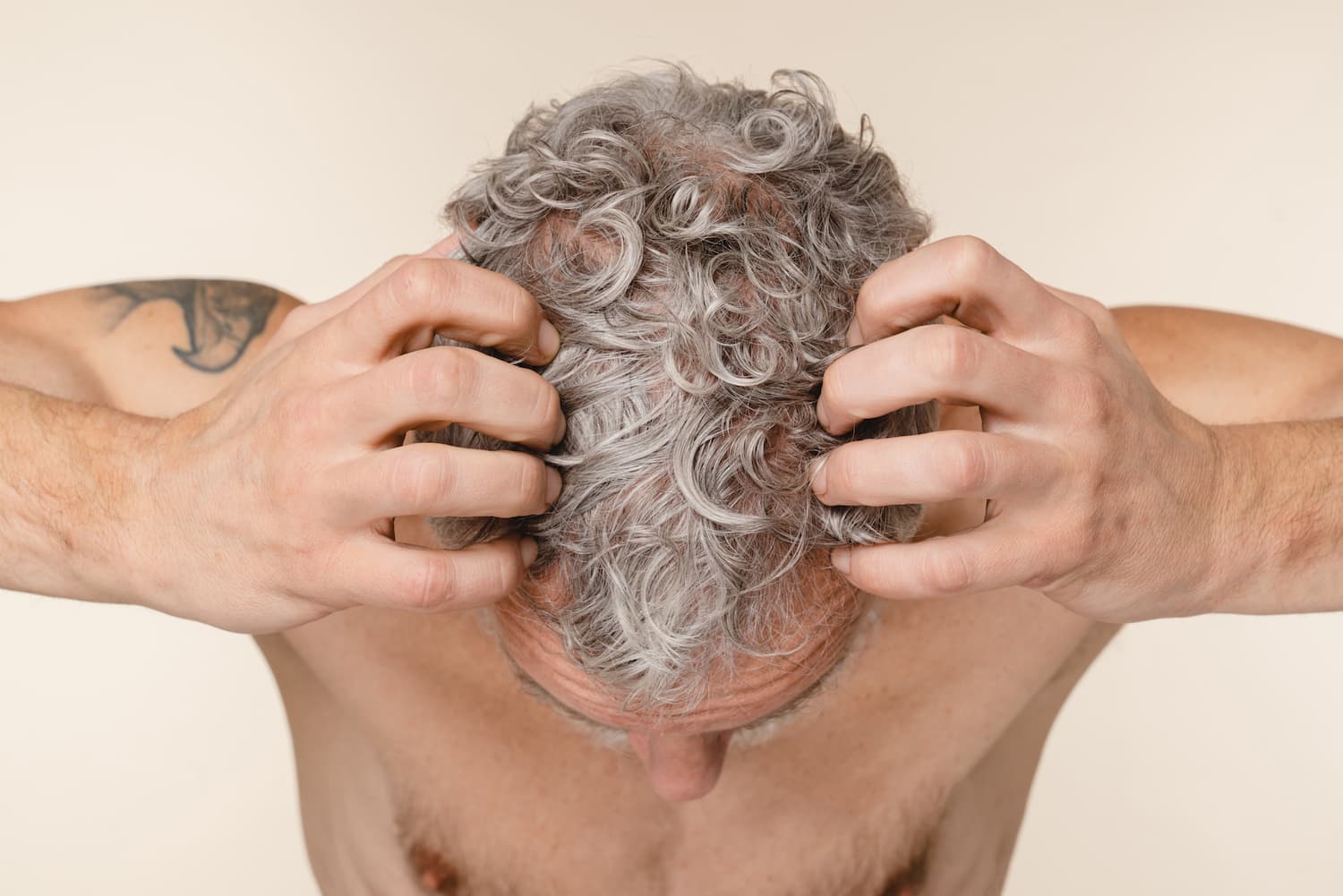 Alopecia Hair Transplant