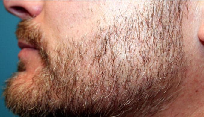 Beard transplants are on the rise