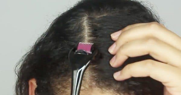 Hair loss Dermaroller