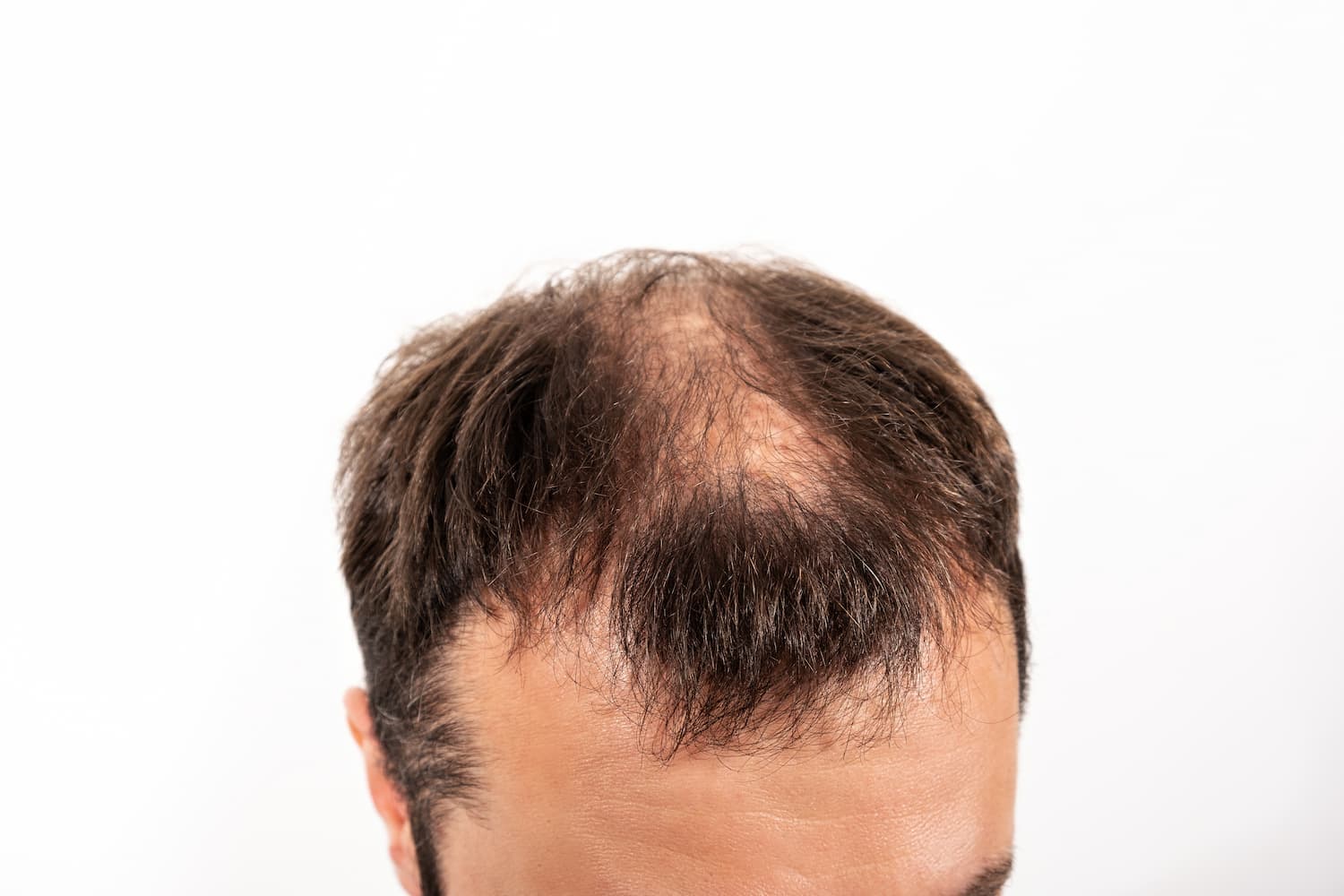 Why Do Hair Transplants Fail?