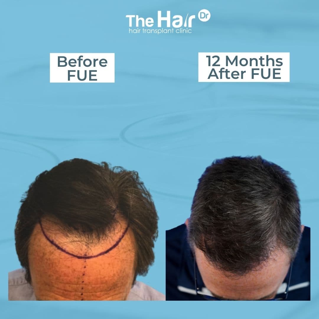 Patient transformation slide 3