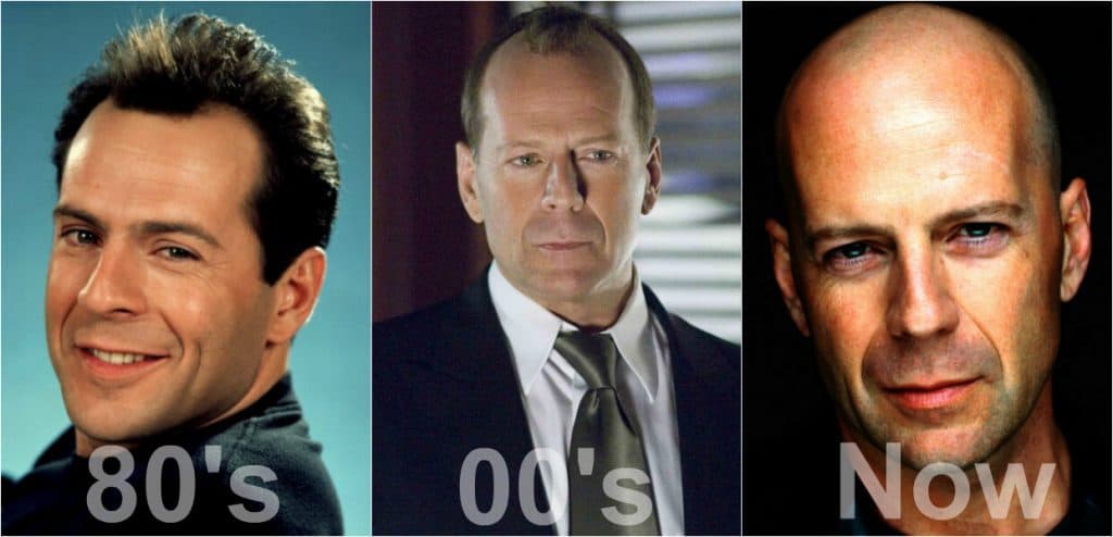 Breaking the Taboo: The Impact of Celebrity Hair Transplants
