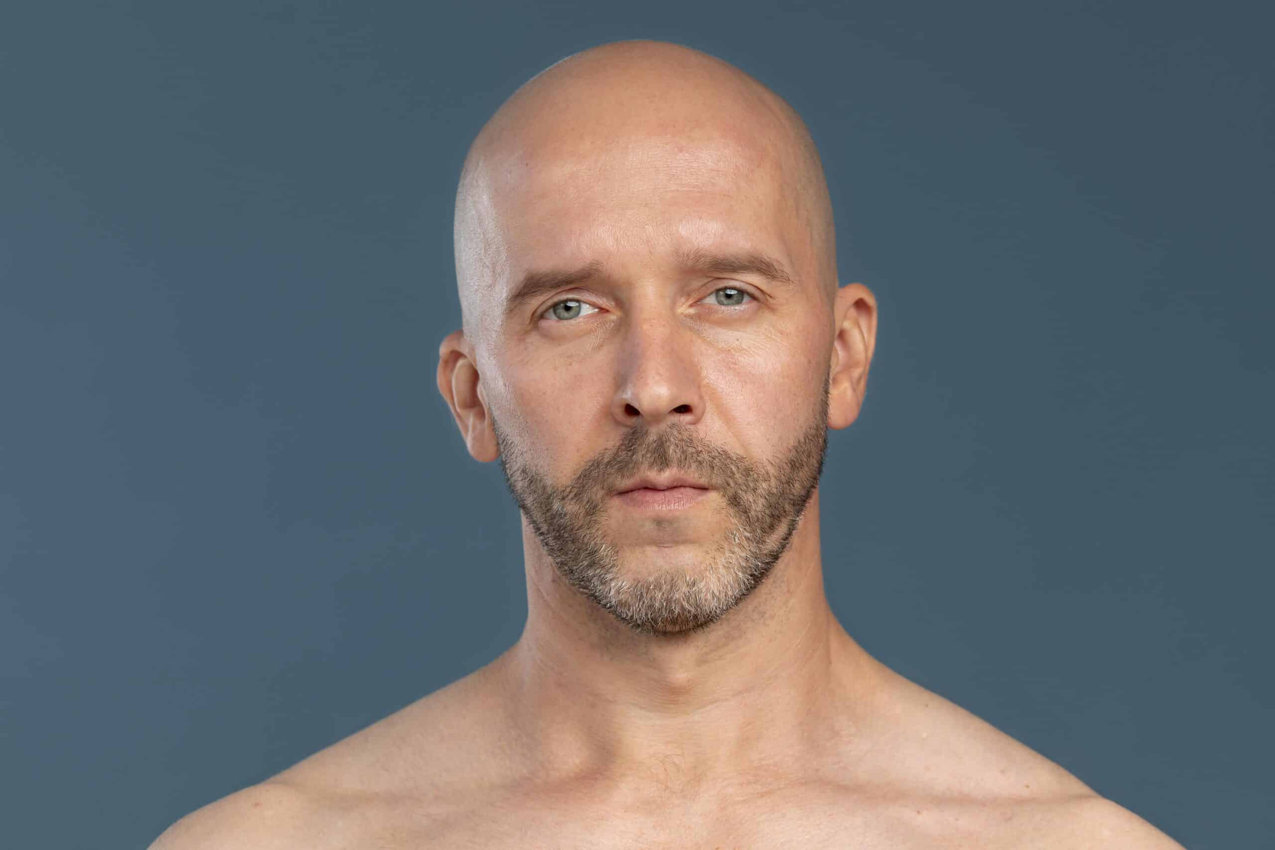 Can You Get a Hair Transplant if You Are Completely Bald?