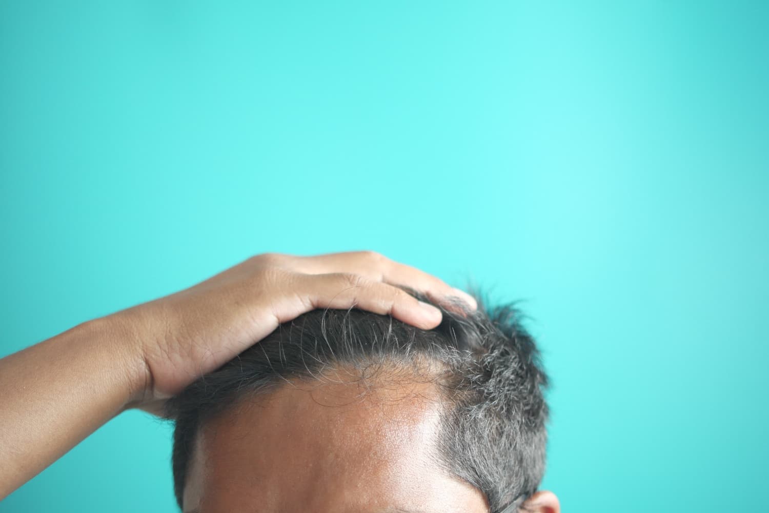 Can You Use Someone Else’s Hair for a Hair Transplant?