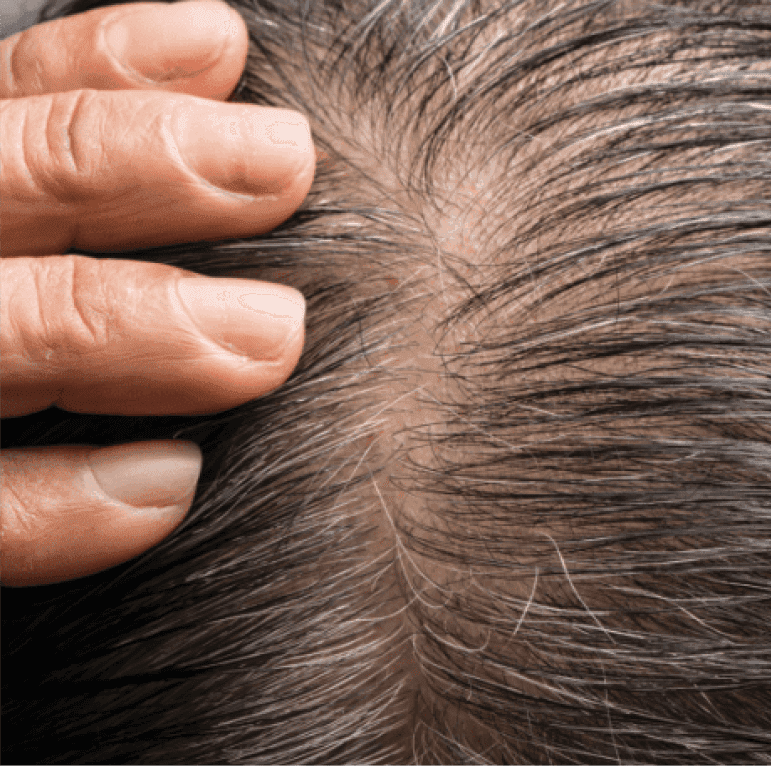 Chemotherapy And Hair Transplants. Lets Talk!