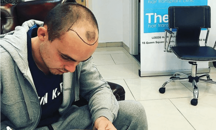 A guide to choosing the right hair transplant clinic