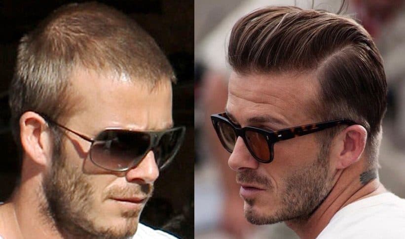David Beckham - Hair Transplant or Hair Fibres?