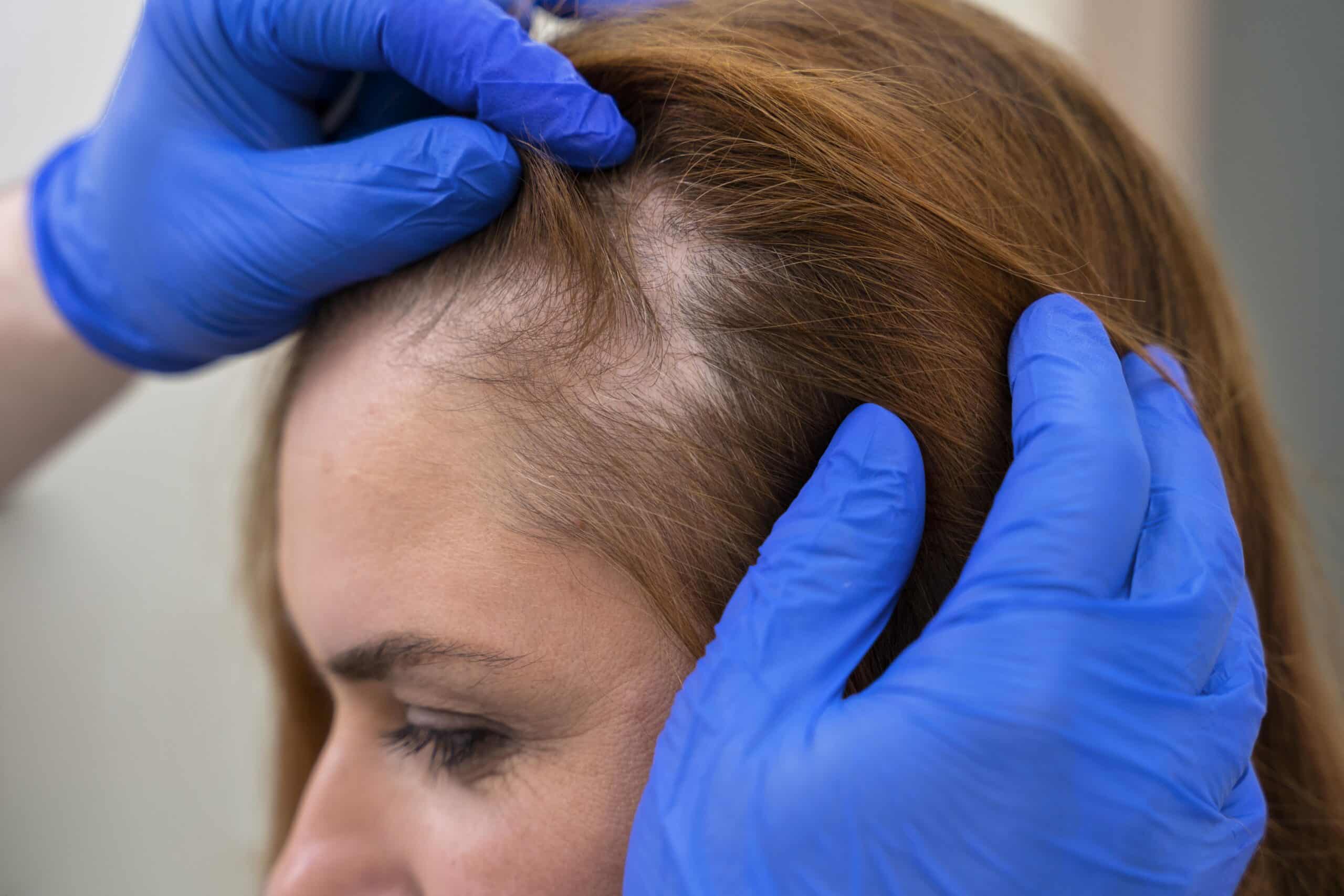 Derma Roller For Hair Loss: How To Get The Best Results Rolling