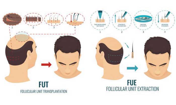 Differences between FUE and FUT hair transplants