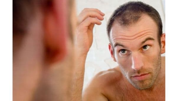 What different types of male and female hair loss?