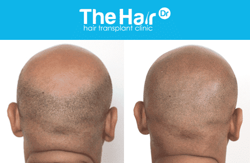 Hair Transplant or Scalp Micropigmentation (SMP)?
