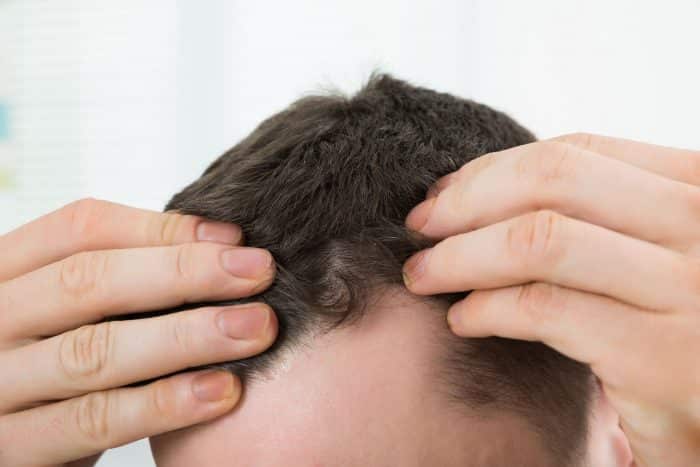 Hair Transplantation FAQs