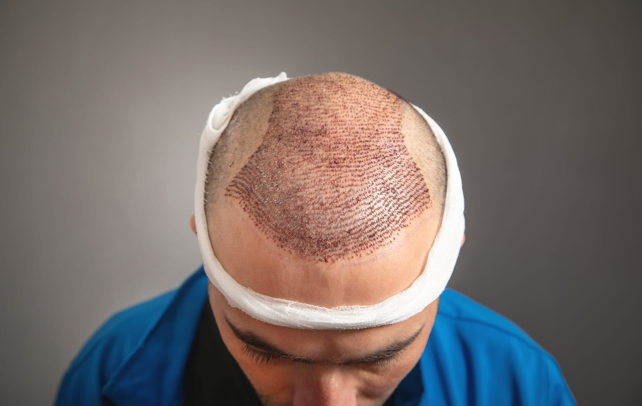 Hair Transplants 2025: The Rise of Natural-Looking FUE Results