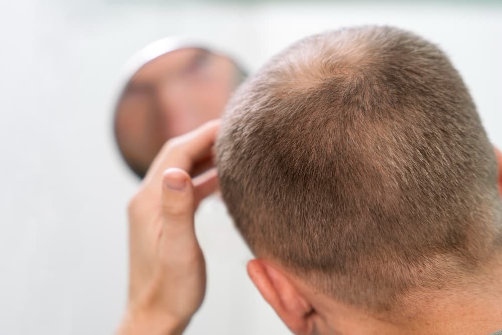 Hair Transplants vs. Hair Loss Medications: Which Is Right for You?