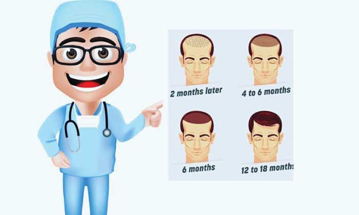How long will a hair transplant last?