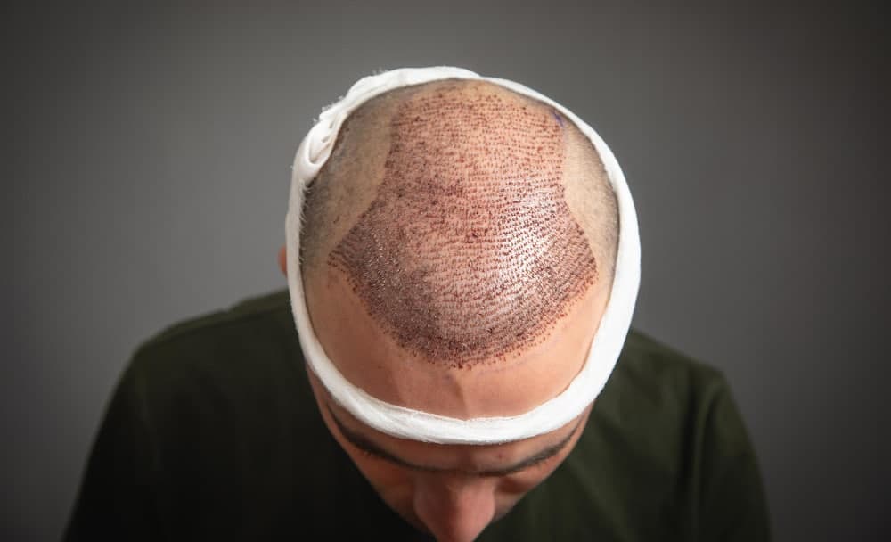 How Many Hair Transplants Are Possible? What’s The Limit?
