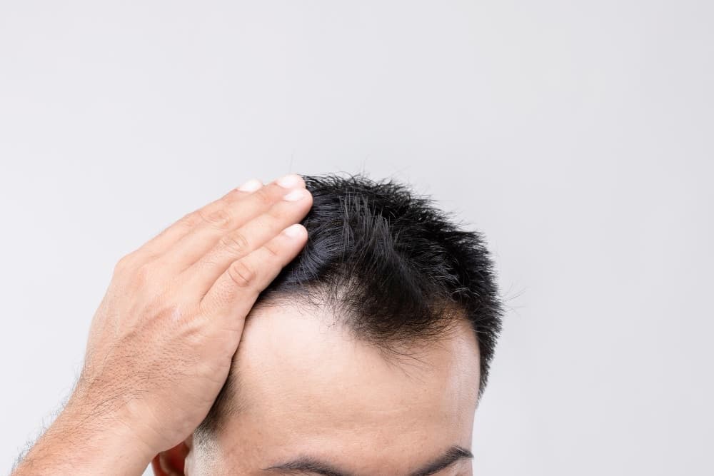 How to Prepare for Your Hair Transplant Surgery
