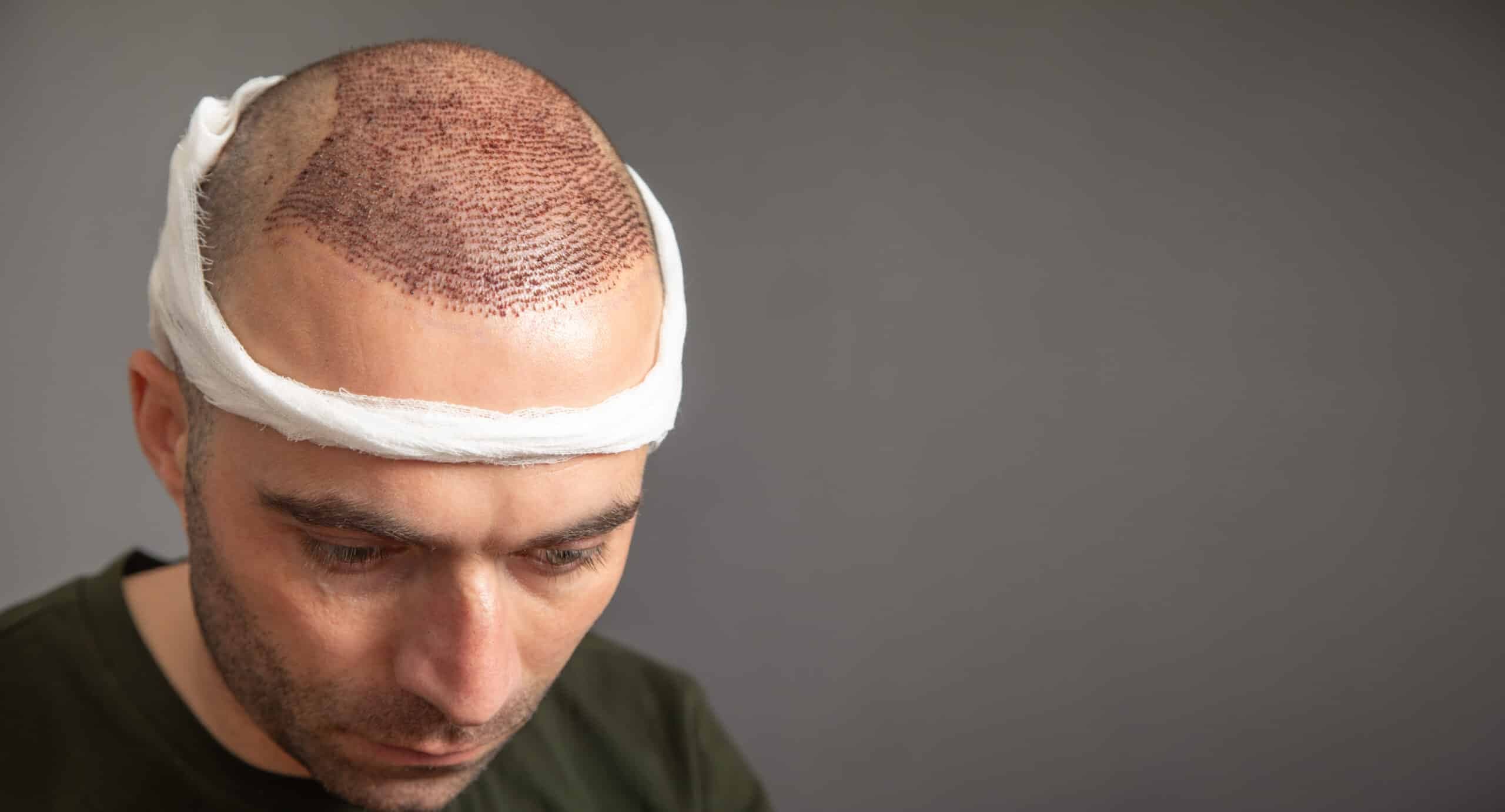 Is a Hair Transplant Done Under General Anaesthesia?