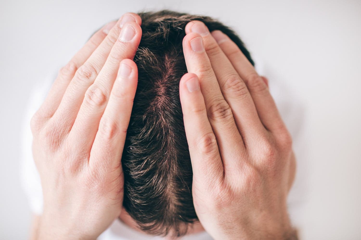 Is Hair Loss Reversible? Exploring Your Options