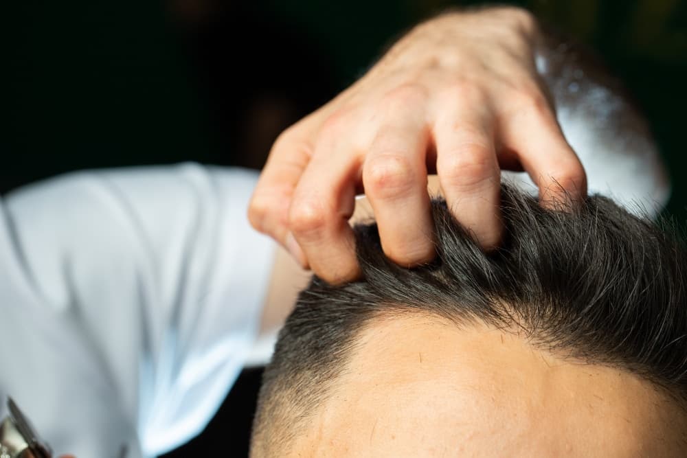 Itching After Hair Transplant: Why It’s Completely Normal