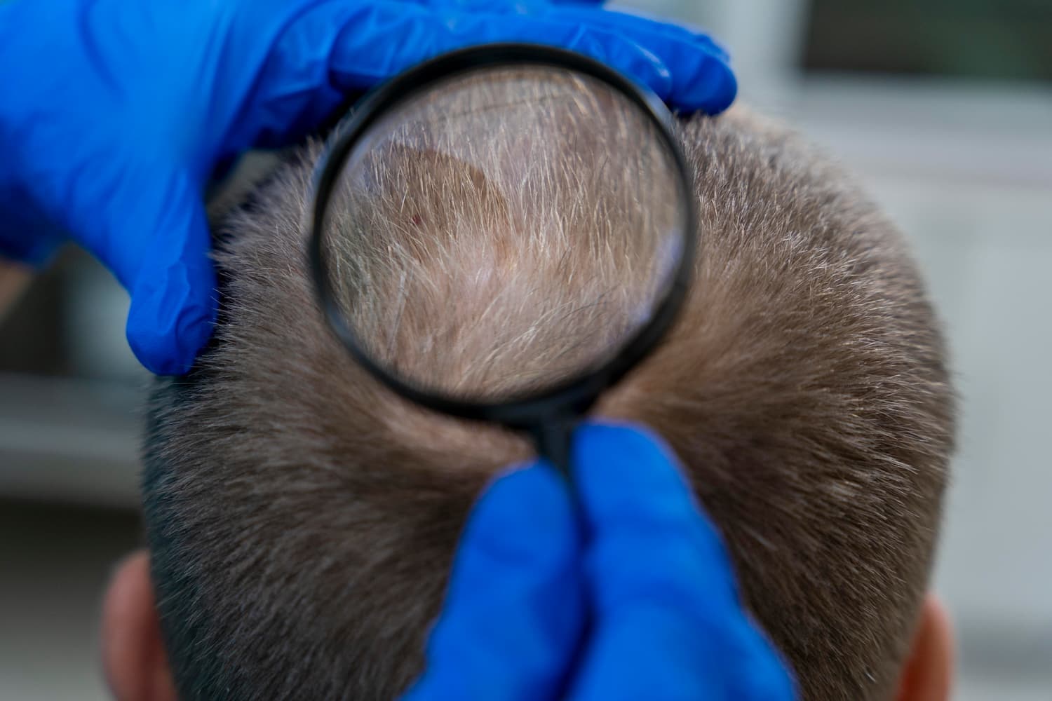 UK vs Turkey for Your Hair Transplant