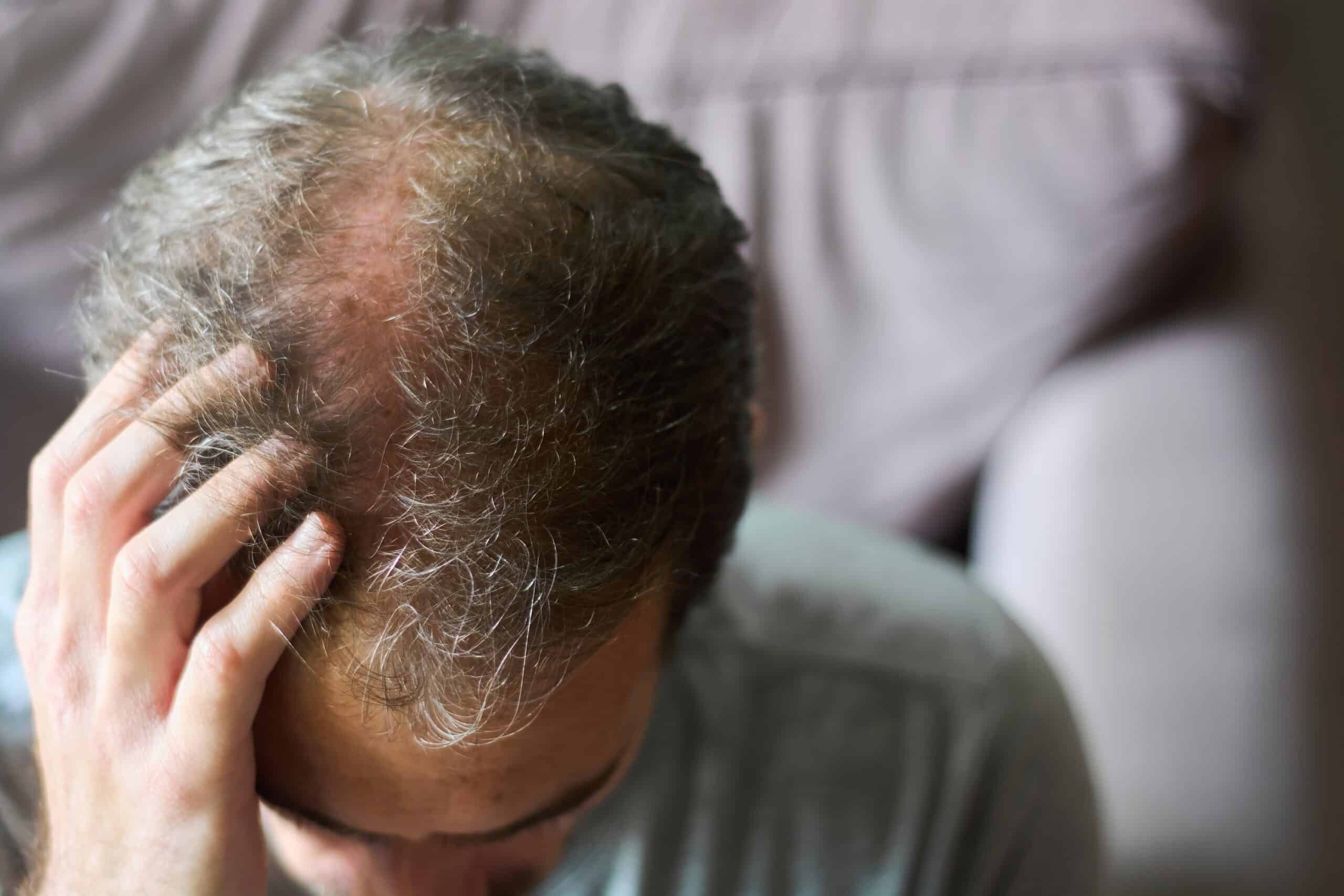 What are the common signs of balding?