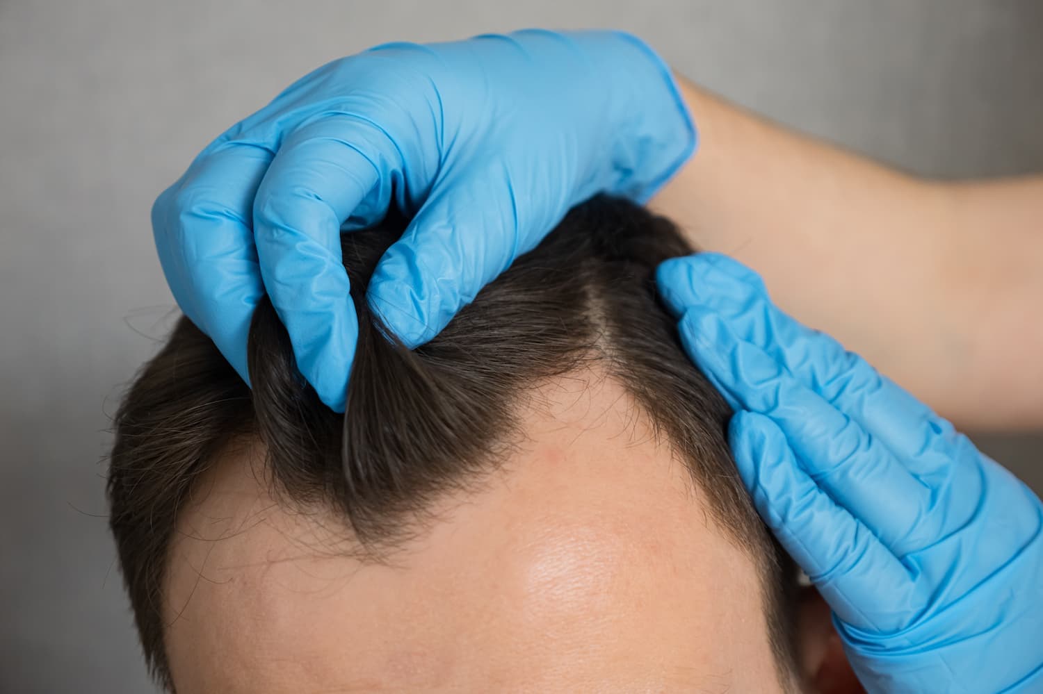 What are the Side Effects of a Hair Transplant?