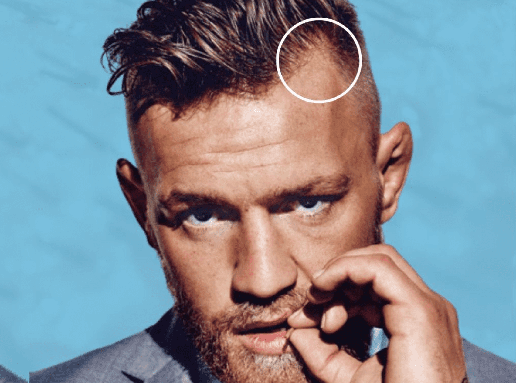What happened to Conor McGregor’s hairline?