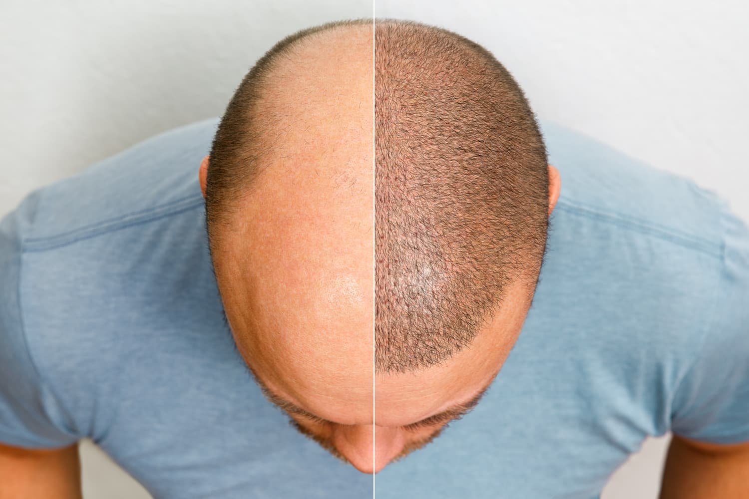 What to Expect with Your Hair Transplant After 10 Years