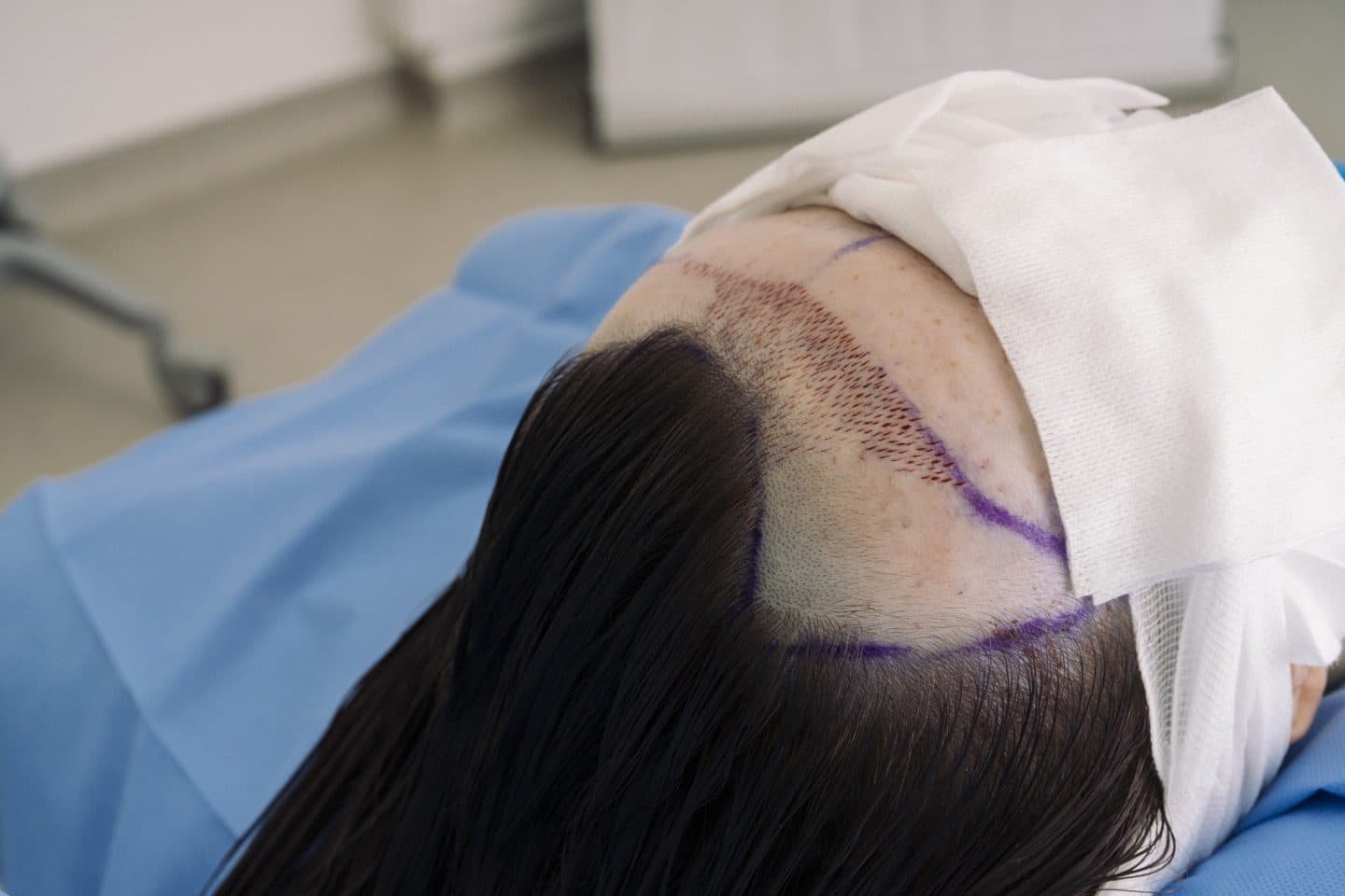 Why Age Matters in Hair Transplants (and When to Get One)