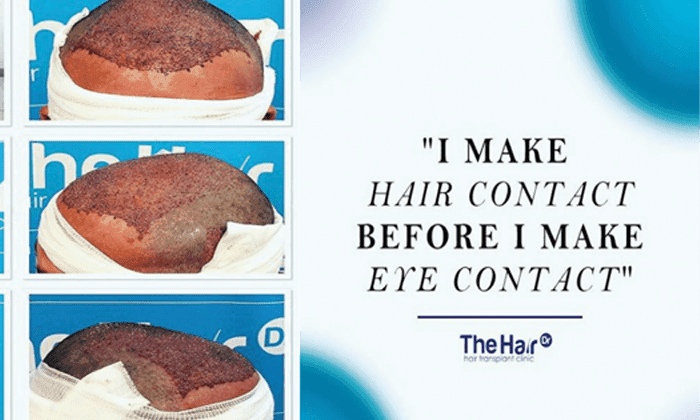So why do crusts form after a hair transplant?