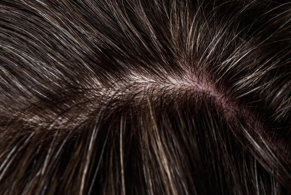 Why Is Your Hair Transplant Not Dense or Thick Enough?