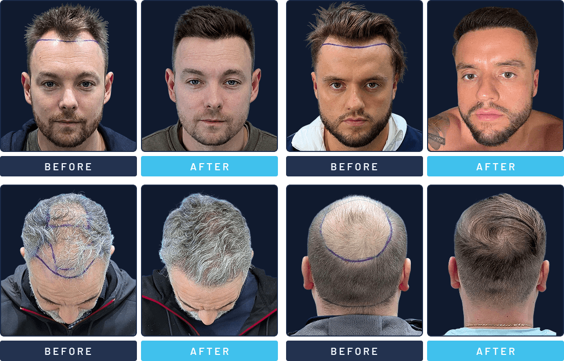 Before and after full coverage hair transplant results from four Hair Dr patients