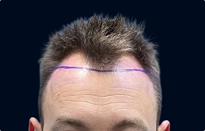 Patient with a receding hairline marked for treatment