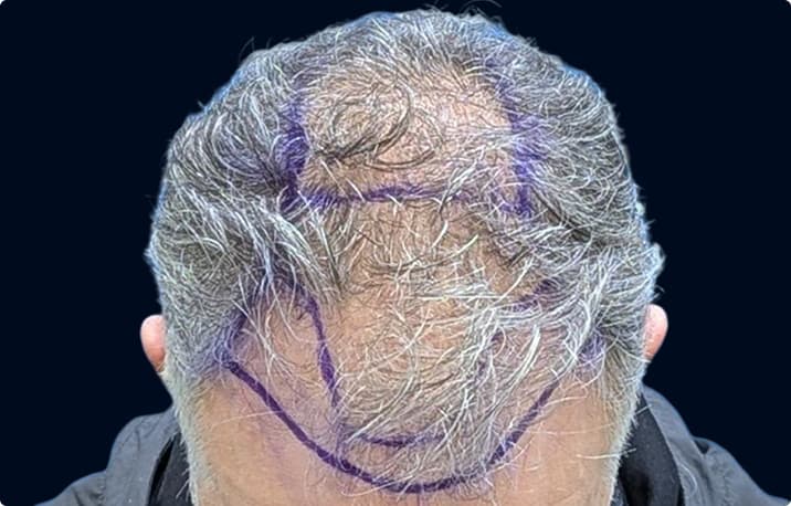 Patient with thinning across the mid-scalp marked for treatment