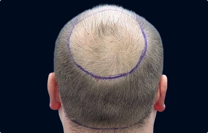 Patient with crown hair loss marked for treatment